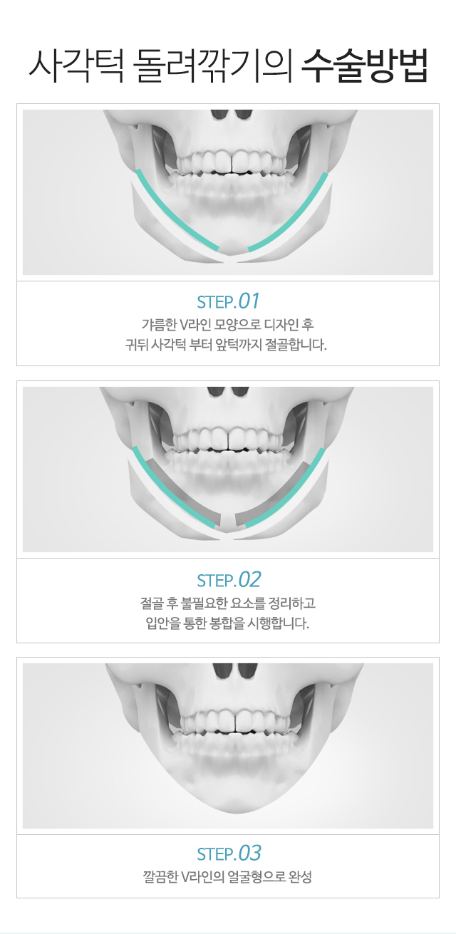 사각턱 돌려깎기의 수술방법:1)갸름한 V라인 모양으로 디자인 후 귀끝 사각턱 부터 앞턱까지 절골합니다. 2)절골 후 불필요한 요소를 정리하고 입안을 통한 봉합을 시행합니다. 3)깔끔한 V라인의 얼굴형으로 완성