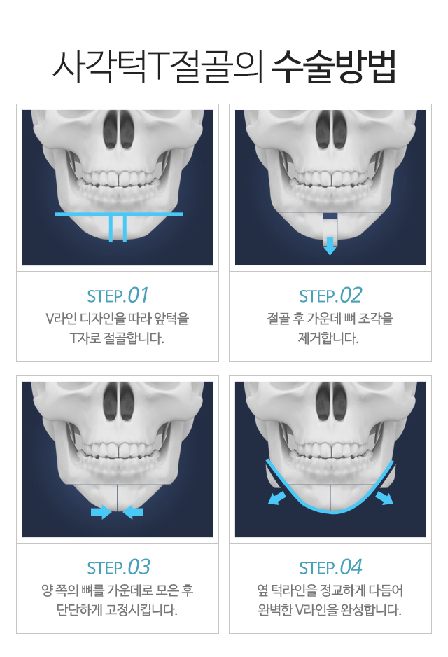 사각턱T절골의 수술방법:1)V라인 디자인을 따라 앞턱을 T자로 절골합니다. 2)절골 후 가운데 뼈 조각을 제거합니다. 3)양 쪽의 뼈를 가운데로 모은 후 단단하게 고정시킵니다. 4)옆 턱라인을 정교하게 다듬어 완벽한 V라인을 완성합니다.