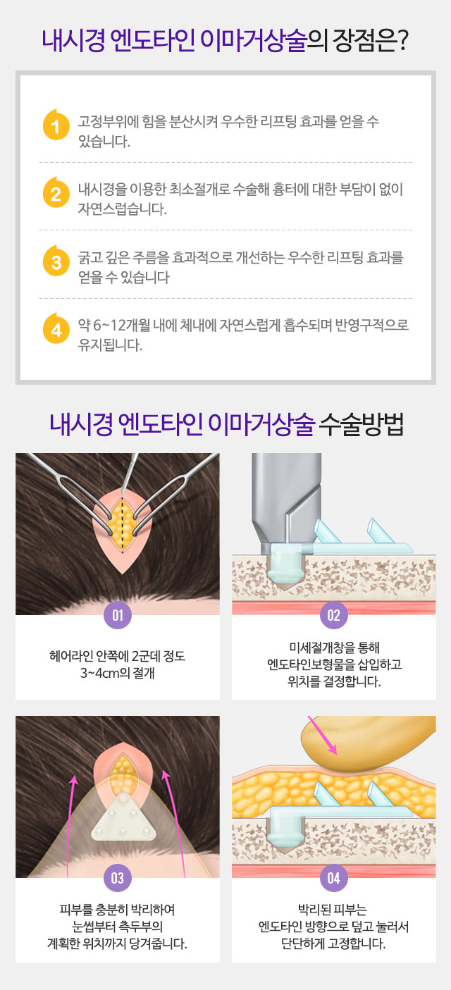 내시경 엔도타인 이마거상술의 장점은? 내시경 엔도타인 이마거상술 수술방법