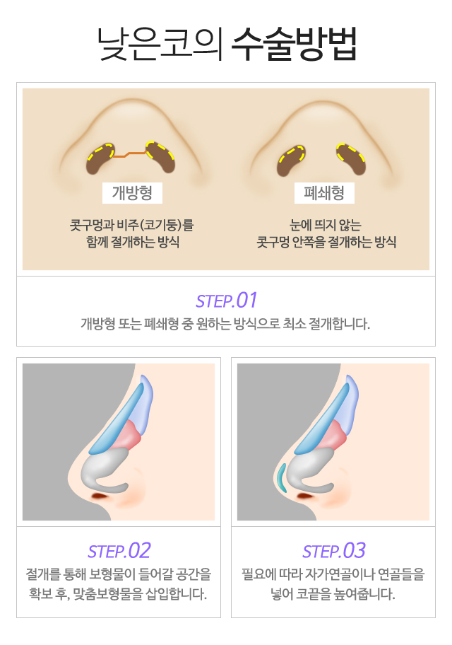 낮은 코 POINT:1)인상을 좌우하는 코 2)얼굴의 볼륨감을 결정하는 콧대 3)오똑하고 입체적인 콧대 4)세련된 이미지로 변신