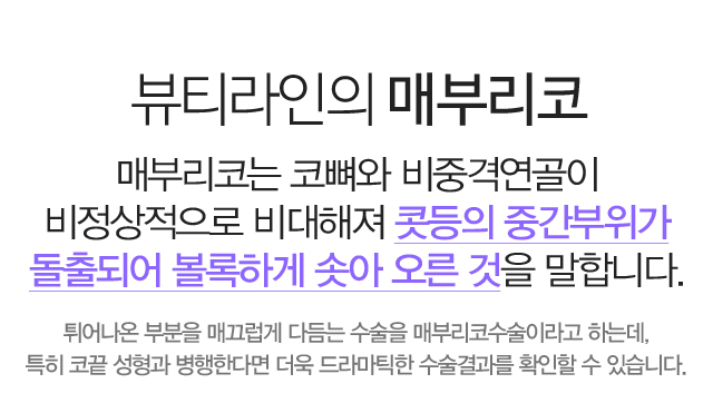 뷰티라인의 매부리코:매부리코는 코뼈와 비중격연골이 비정상적으로 비대해져 콧등의 중간부위가 돌출되어 볼록하게 솟아 오른 것을 말합니다. 튀어나온 부분을 매끄럽게 다듬는 수술을 매부리코수술이라고 하는데, 특히 코끝 성형과 병행한다면 더욱 드라마틱한 수술결과를 확인할 수 있습니다.